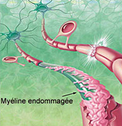 vitamine-b12-carence-myeline